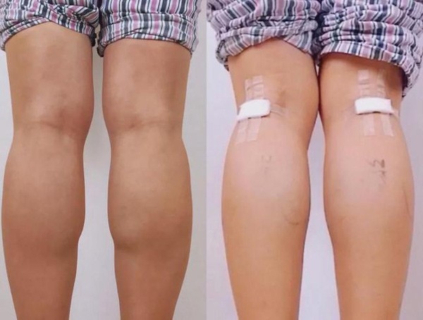 Làm đẹp rùng rợn của giới trẻ: Cắt dây thần kinh để chân thon