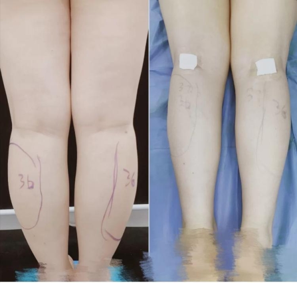 Làm đẹp rùng rợn của giới trẻ: Cắt dây thần kinh để chân thon