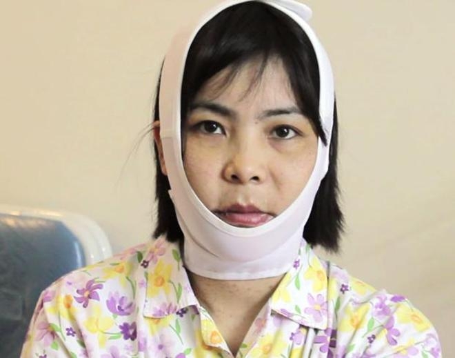 Trượt cằm vốn phức tạp và có rủi ro biến chứng cao, vậy chị em cần lưu ý điều gì?