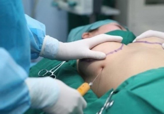 Vỡ túi ngực: diễn tiến âm thầm, biến chứng đáng ngại