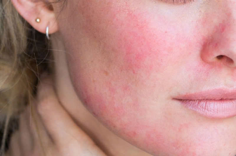 Da khô, mẩn đỏ là một trong những vấn đề thường gặp trong mùa hanh khô.