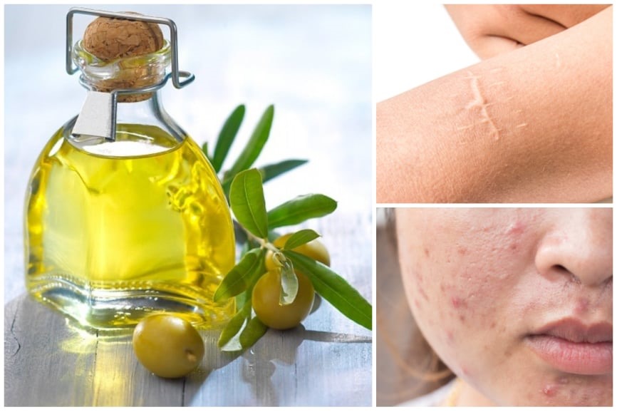 Dầu mù u hỗ trợ làm lành da