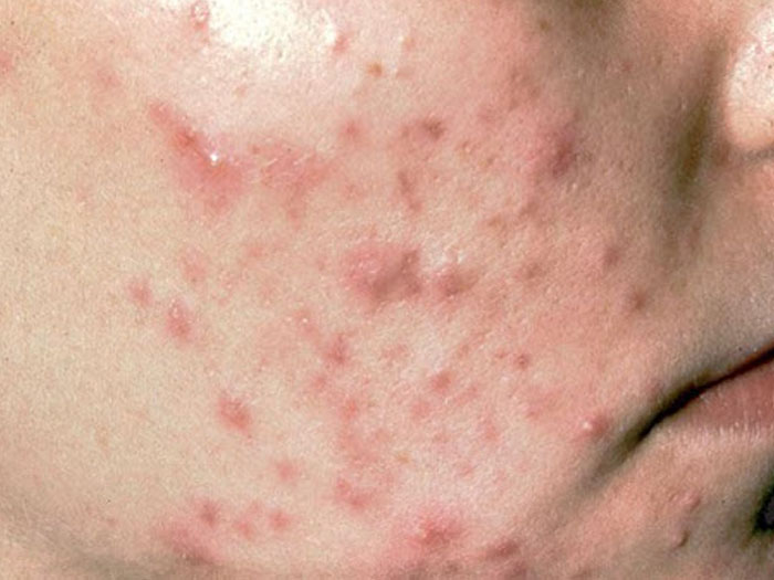 Da mụn viêm đỏ gây đau, khó chịu và mất thẩm mỹ...