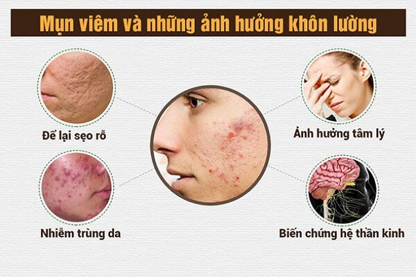 Mụn viêm đỏ nếu không điều trị đúng có thể dẫn đến nhiều biến chứng...