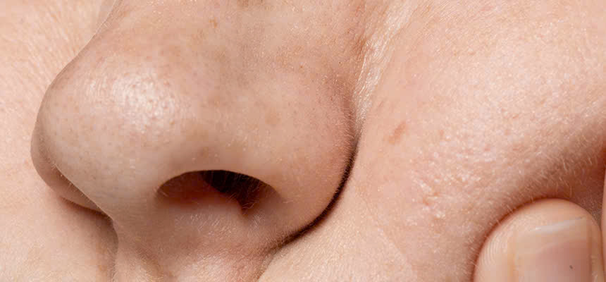 Ảnh làn da bị kích ứng và khô, dễ mẫn cảm