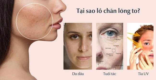 Vì sao lỗ chân lông to? (Nguồn: Internet)