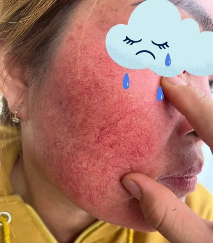 Sau thời gian sử dụng kem trộn sẽ khiến da mỏng, đỏ, nổi mạch máu... Nguồn: Theo Sức khỏe và Đời sống