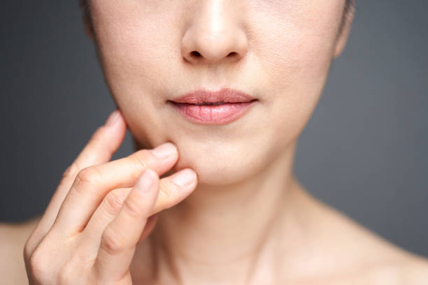 Cơ mặt chảy xệ và mất độ sắc nét làm xuất hiện rãnh cười, các nếp nhăn sâu.