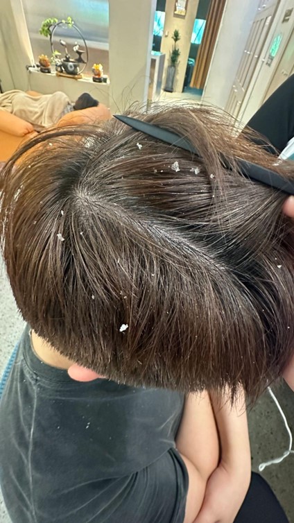 Da đầu gàu ngứa bong tróc