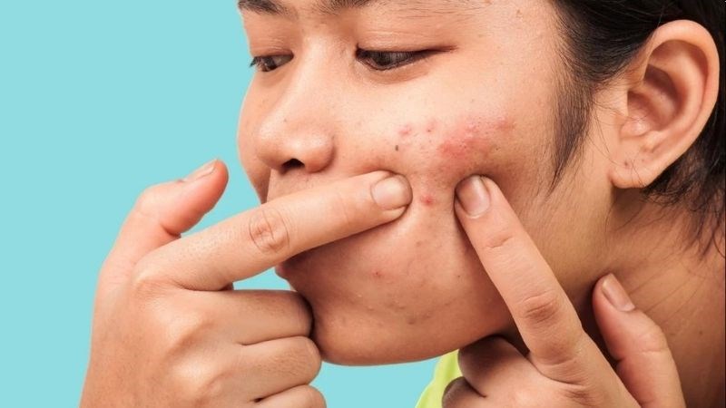 Nên lấy nhân mụn tại cơ sở da liễu uy tín, khi mụn đã "chín" và được thực hiện bằng dụng cụ vô khuẩn.