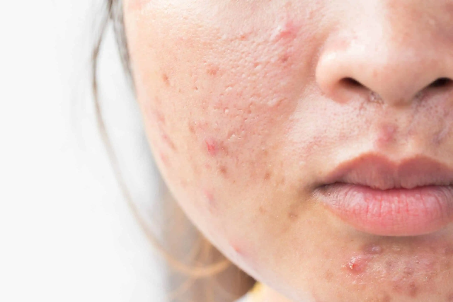 Vi khuẩn Cutibacterium acnes - tác nhân chính gây mụn trứng cá