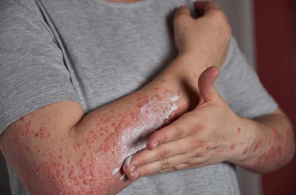 Khi mắc viêm da dị ứng người bệnh cần tuân thủ chỉ định của các bác sĩ.