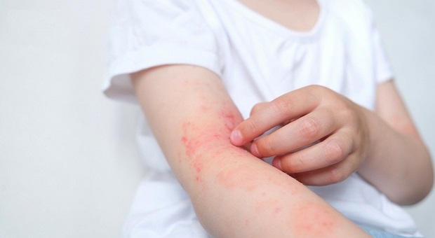 Nhiều người lầm tưởng da dầu không cần dưỡng ẩm khi bị viêm da dị ứng.