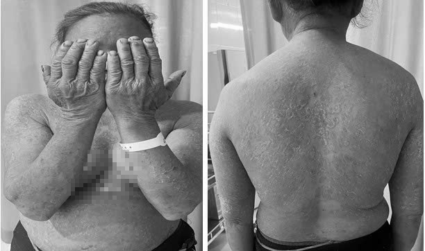 Bệnh nhân có tổn thương dát, mảng đỏ bong vảy da lan toả toàn thân kèm theo ngứa nhiều do nhiễm nấm da