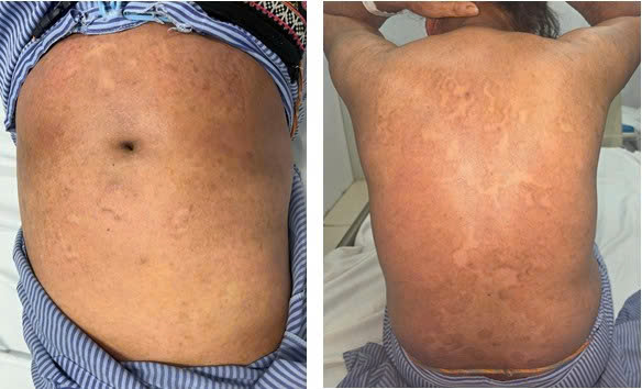 Tổn thương do nấm da của bệnh nhân cải thiện sau 3 ngày điều trị.