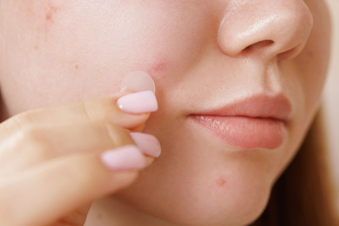 Miếng dán mụn rất tiện lợi, nhưng nếu dùng sai, bạn có thể làm da viêm nặng hơn hoặc khiến vết thương chậm lành.