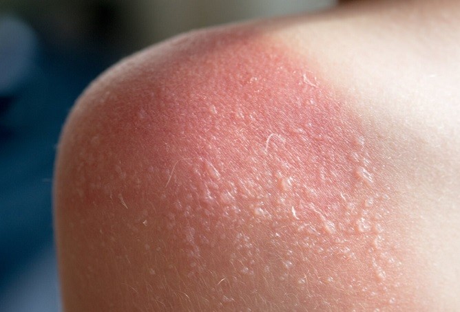 Làn da bị cháy nắng phồng rộp nặng.