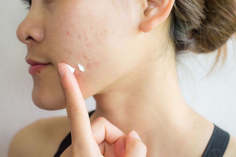 Việc lựa chọn kem chống nắng phù hợp, không chứa cồn và hương liệu, là điều cần thiết để bảo vệ làn da mụn.