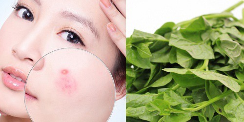 Rau mồng tơi có tác dụng hỗ trợ điều trị mụn trứng cá là nhờ có đặc tính sinh học đặc biệt.