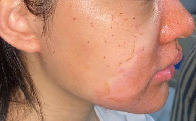 Tổn thương trên da bệnh nhân sau khi peel da tại cơ sở spa.