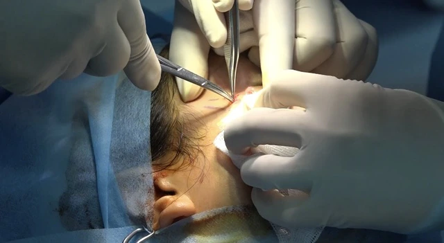 Một trường hợp bệnh nhân bị biến chứng áp xe mặt sau căng chỉ vùng mặt. Ảnh tư liệu.