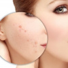 Phương pháp trị mụn hiệu quả do châu Âu, Hàn Quốc công bố được đưa vào nghiên cứu tại Việt Nam