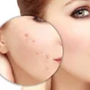 Phương pháp trị mụn hiệu quả do châu Âu, Hàn Quốc công bố được đưa vào nghiên cứu tại Việt Nam