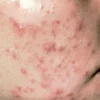 Dùng thuốc và cách chăm sóc da mụn viêm đỏ tại nhà