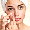 6 thói quen xấu gây mụn trứng cá