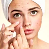 6 thói quen xấu gây mụn trứng cá