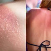 Cách khắc phục làn da bị cháy nắng