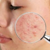 Mụn ẩn dưới da: “Kẻ thù vô hình” của làn da và 3 bước xử lý hiệu quả