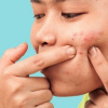 Những sai lầm khi chữa mụn trứng cá