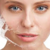 Peel da mặt làm đẹp, cô gái mọc chi chít mụn nước, vỡ chảy dịch