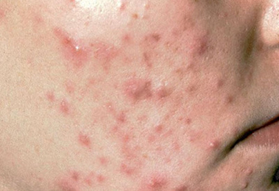 Dùng thuốc và cách chăm sóc da mụn viêm đỏ tại nhà