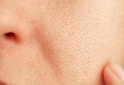 Cách thu nhỏ lỗ chân lông tại nhà đơn giản mà hiệu quả