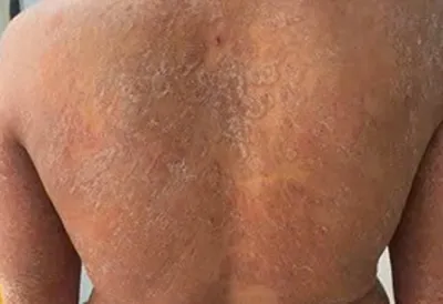 Dùng sai thuốc, nấm da lan toàn thân, ngứa dữ dội