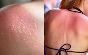 Cách khắc phục làn da bị cháy nắng