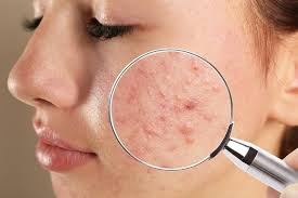 Mụn ẩn dưới da: “Kẻ thù vô hình” của làn da và 3 bước xử lý hiệu quả