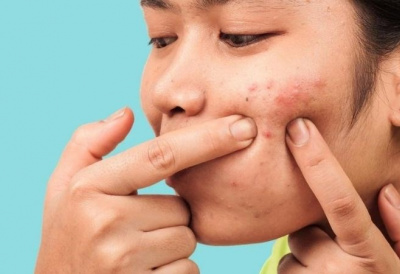 Những sai lầm khi chữa mụn trứng cá