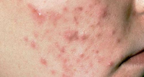 Dùng thuốc và cách chăm sóc da mụn viêm đỏ tại nhà