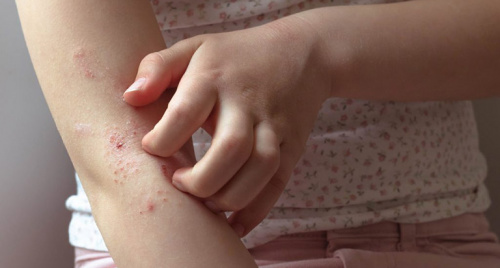 Cách phòng chứng ngứa da, nổi mề đay vào mùa xuân