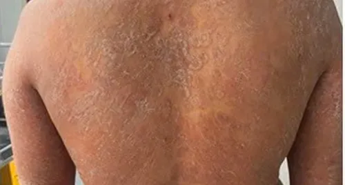 Dùng sai thuốc, nấm da lan toàn thân, ngứa dữ dội