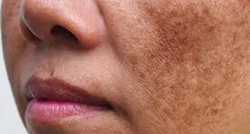 Mẹo chữa nám da từ rau má