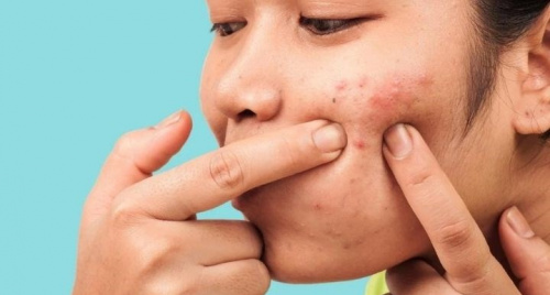 Những sai lầm khi chữa mụn trứng cá