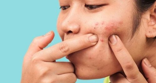 Những sai lầm khi chữa mụn trứng cá