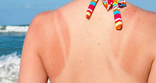 Da cháy nắng và cách dùng rau mồng tơi để xử lý