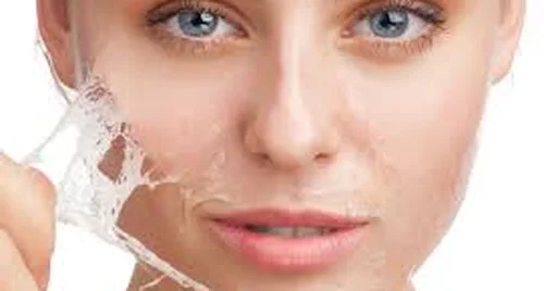 Peel da mặt làm đẹp, cô gái mọc chi chít mụn nước, vỡ chảy dịch