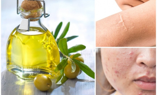 Dầu Mù U - Từ “thuốc trị bỏng” quê nhà đến “vàng xanh” của làn da