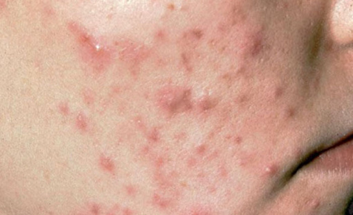 Dùng thuốc và cách chăm sóc da mụn viêm đỏ tại nhà